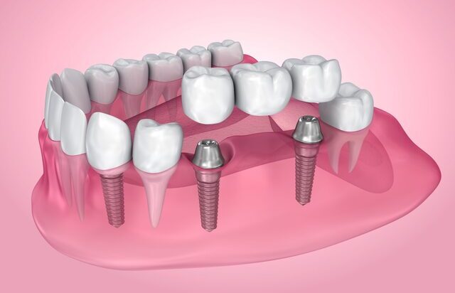 teeth implants auckland